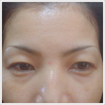 �A�[�g���C�N�{�p�A5������